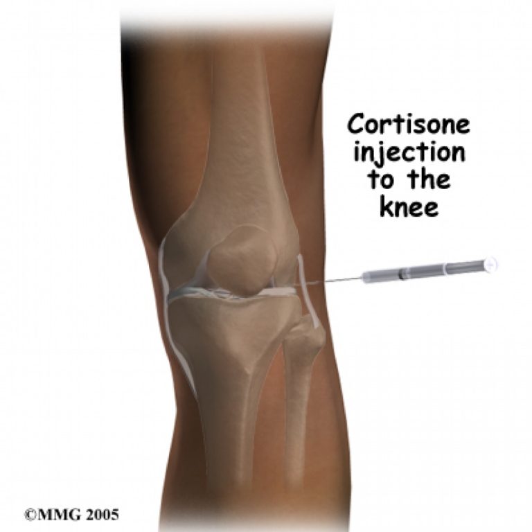 Is steroid injection bad for your knee? | Dr. Shahin S. Rad